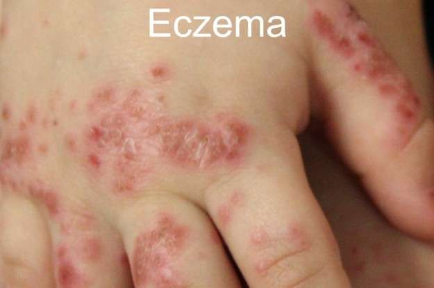 Eczema della pelle delle mani