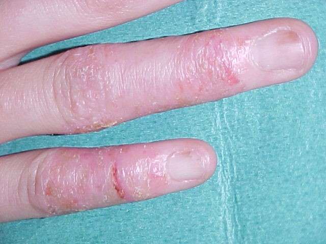 Eczema sulle mani