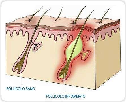 Infiammazione del follicolo