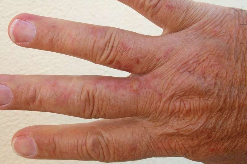 Irritazione della dermatite da contatto