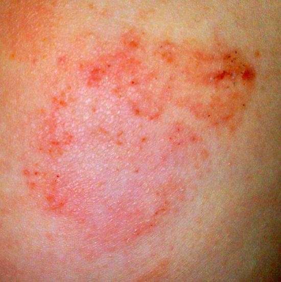 Lesione della dermatite da contatto