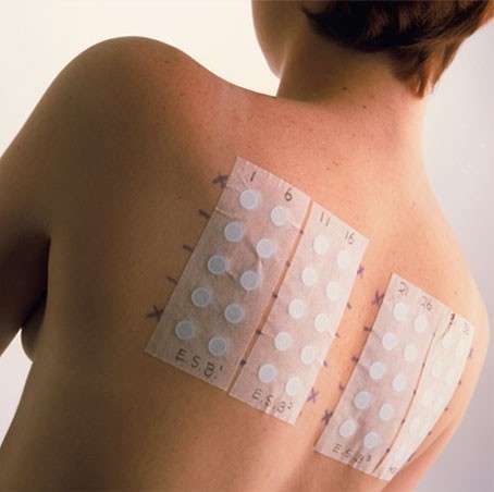 Patch test per la dermatite da contatto