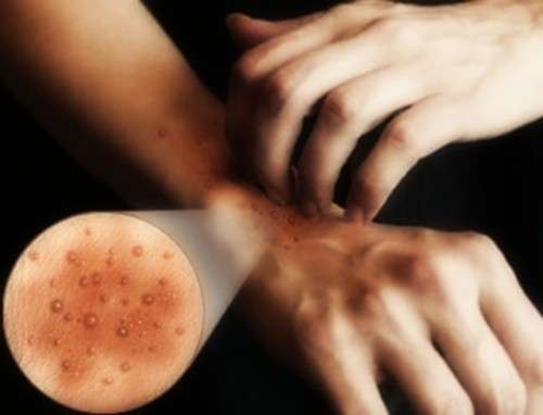 Prurito come sintomo della dermatite