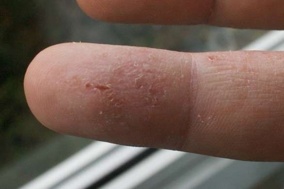 Sintomi della dermatite