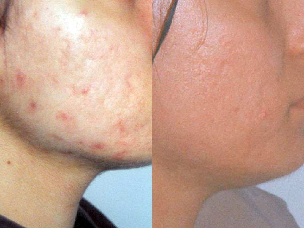 Acne sulla pelle del viso