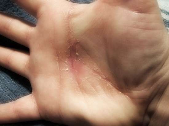 Eczema da contatto sulle mani