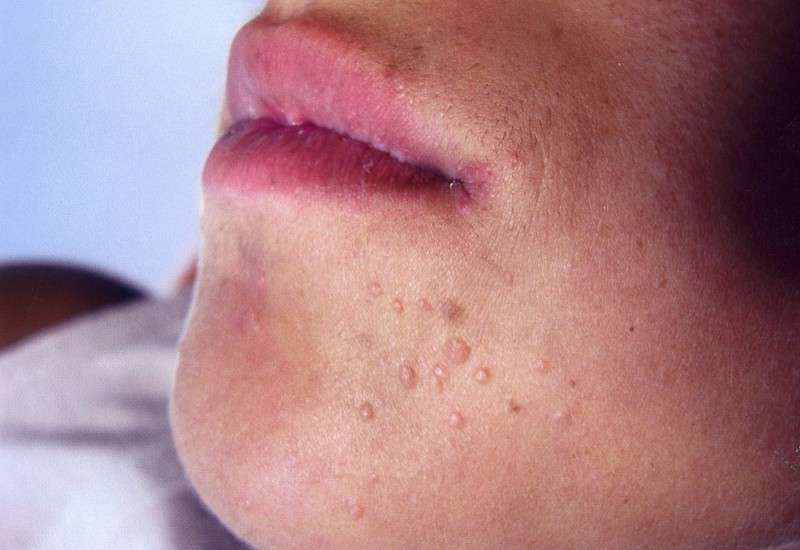 Lesioni sulla pelle del viso