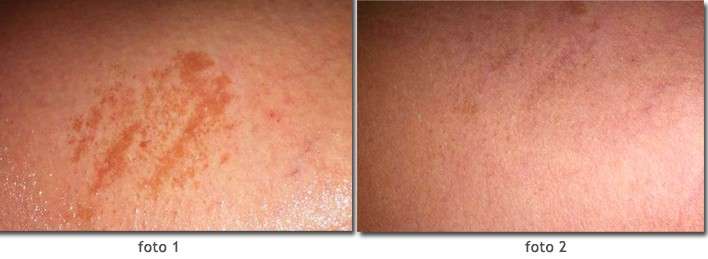Macchie sulla pelle pre e dopo il trattamento