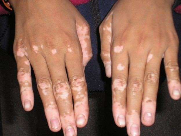 Mani con vitiligo