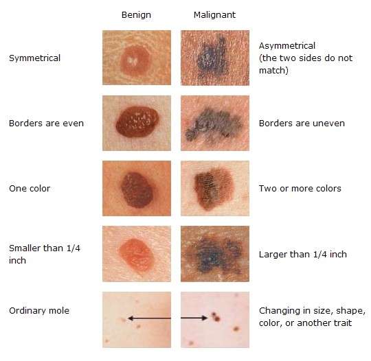 Melanoma sulla pelle