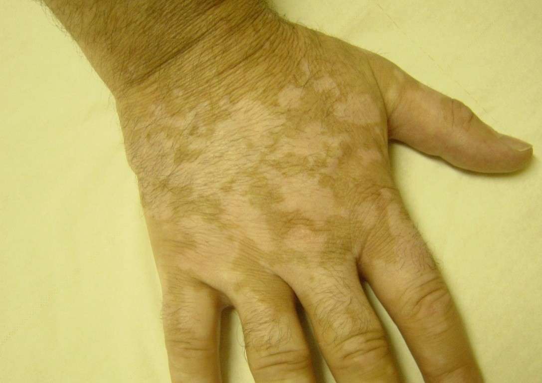 Vitiligine sulla pelle delle mani