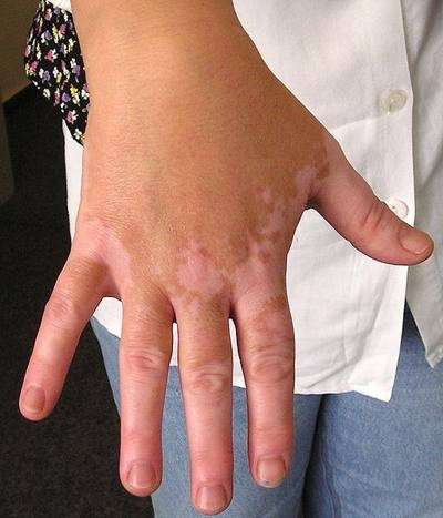 Vitiligo sulla pelle