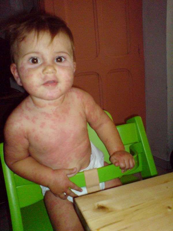 Bambino con eczema