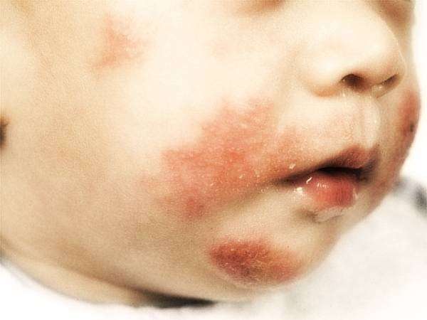 Bambino con la dermatite