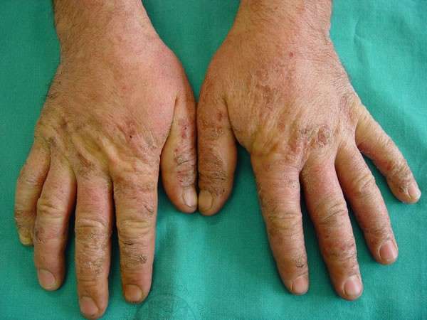Dermatite anche sulle mani