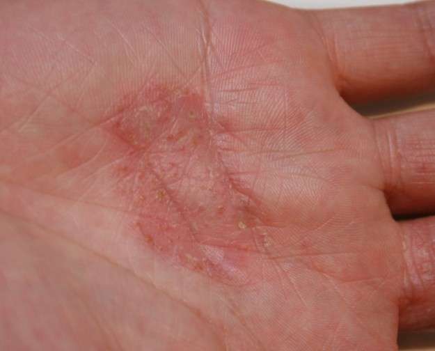 Dermatite atopica foto