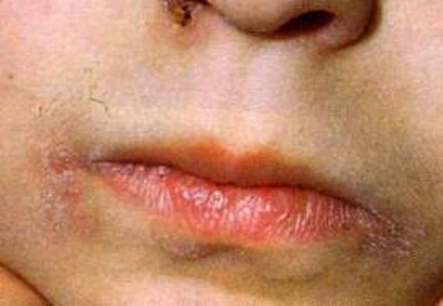 Dermatite intorno alle labbra