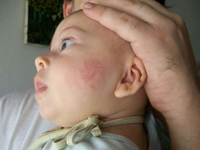 Dermatite nel neonato