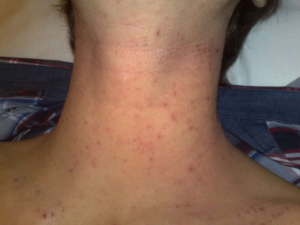 Dermatite sul collo