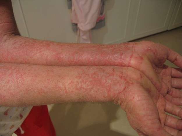 Dermatite sulle braccia