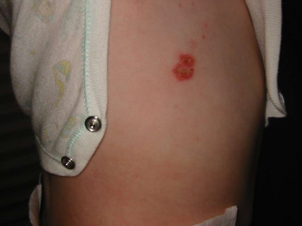 L'impetigine volgare