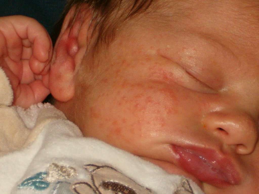La dermatite dei bambini