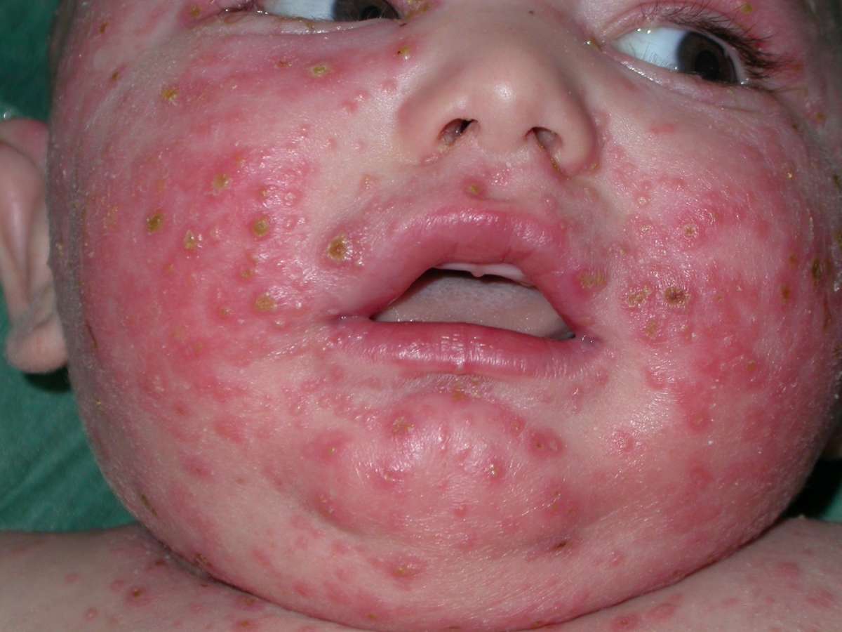 La dermatite nei neonati