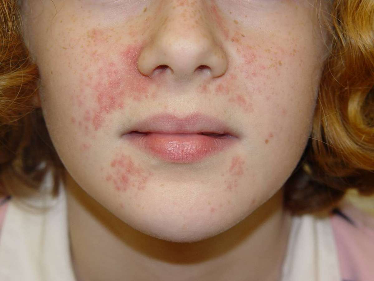 La dermatite nel viso dei bambini
