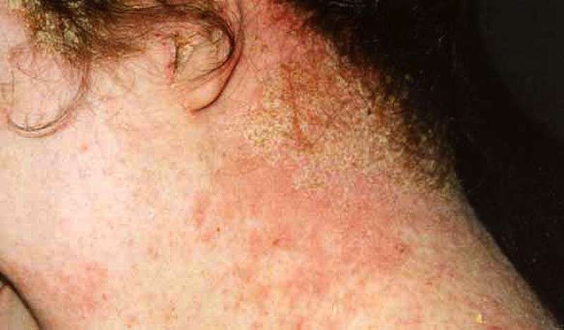 Lesioni della dermatite atopica