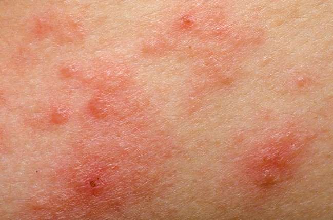 Sintomi della dermatite atopica