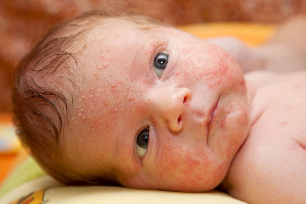 Dermatite sul neonato