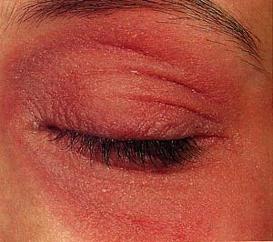 Dermatite sull'occhio