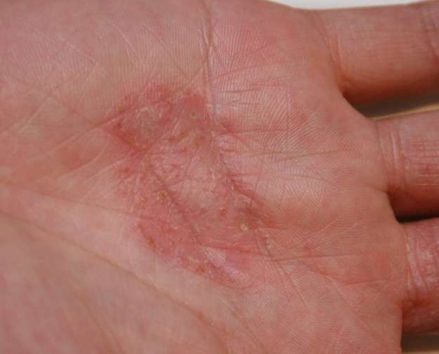 Dermatite sulla mano