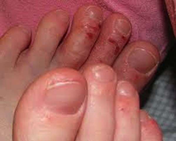 Dermatite sulle dita