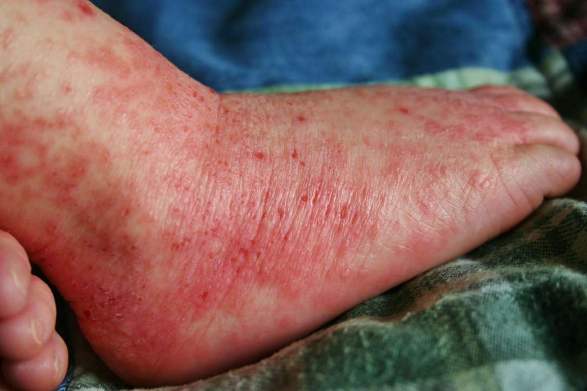 Eczema sul piede