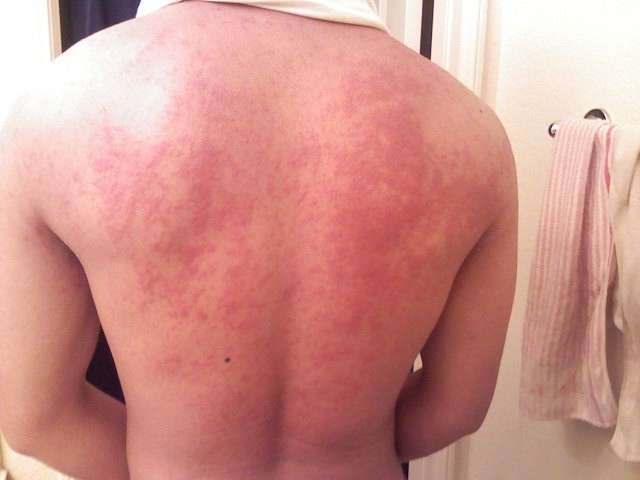 Eczema sulla schiena