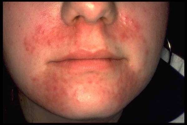 La dermatite colpisce il viso