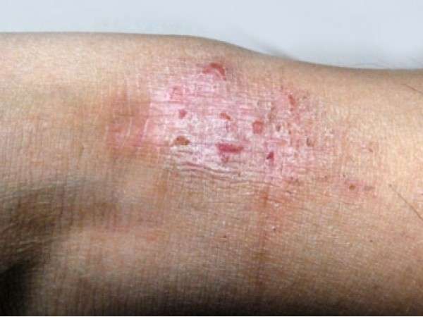 Lesione da dermatite