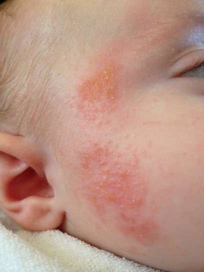 Sintomi della dermatite sul viso