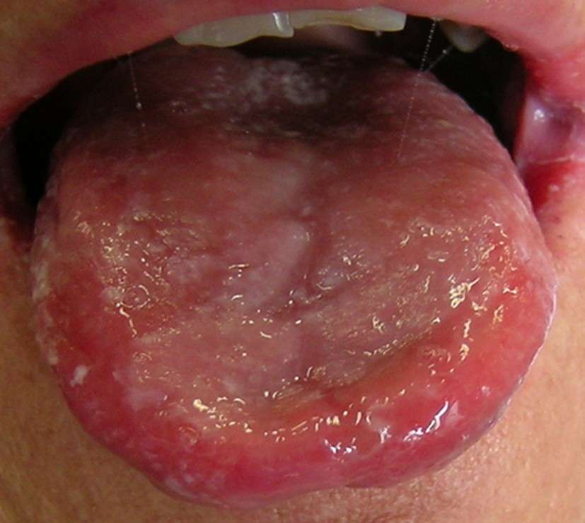 Infiammazione della mucosa orale