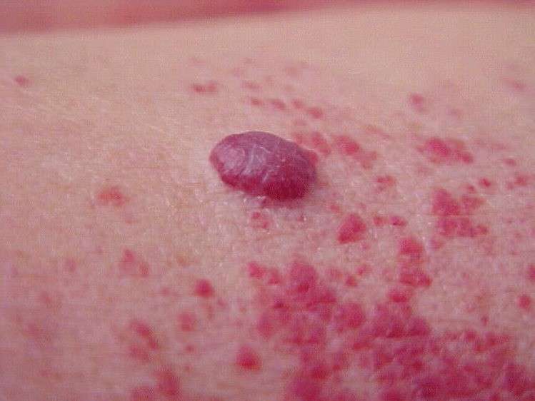 Angioma a ciliegia