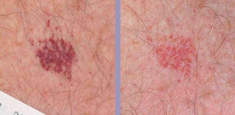 Angioma dopo il laser