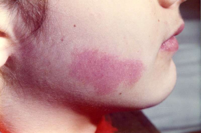 Angioma piano sulla guancia