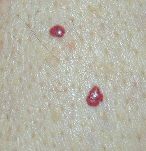 Angioma puntiforme