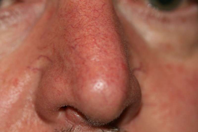 Angioma stellato sul naso