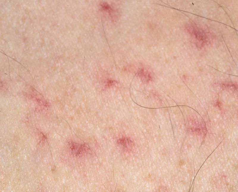 Angiomi stellati sulla pelle