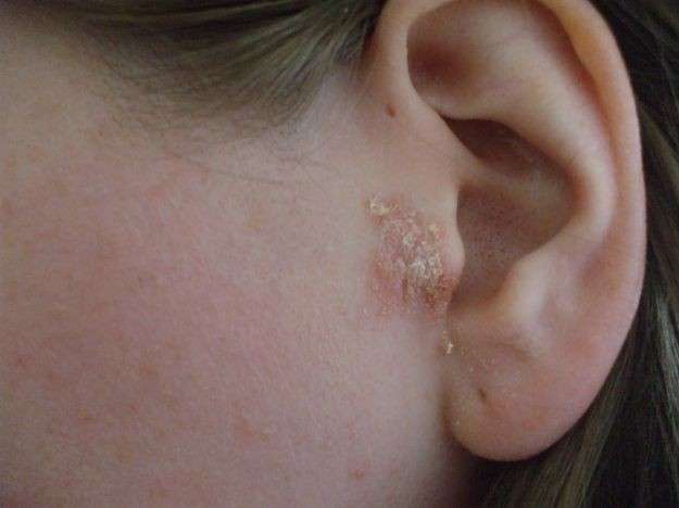 Dermatite seborroica sulla pelle