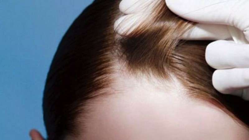 Dermatite tra i capelli