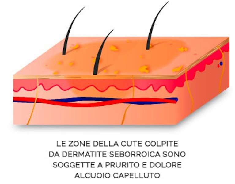 Sintomi della dermatite sulla pelle