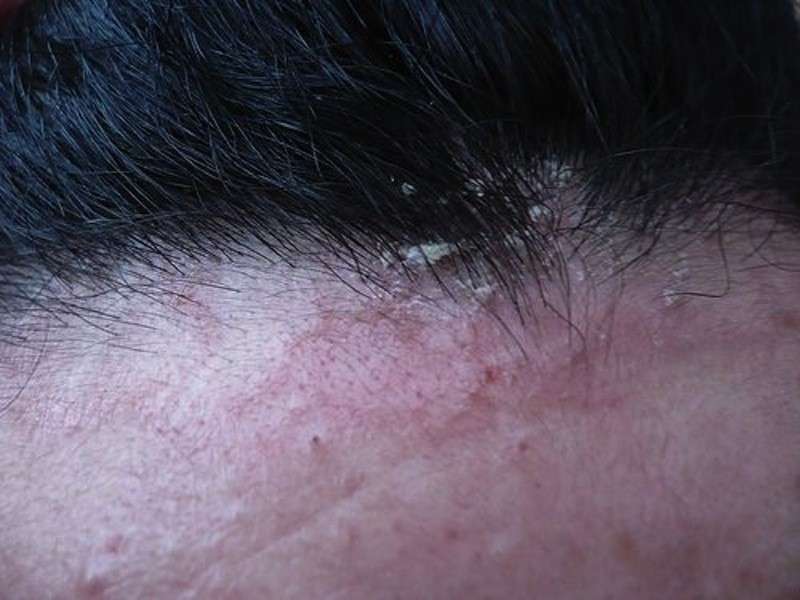 Sintomi della dermatite tra i capelli